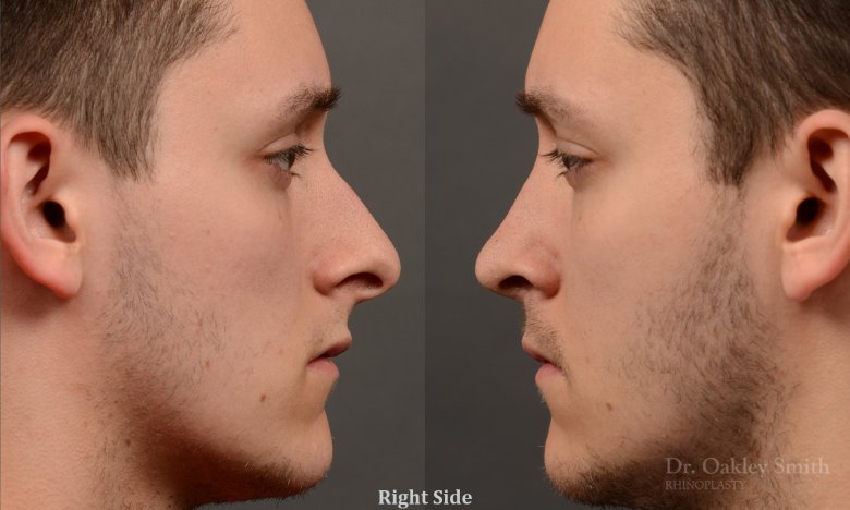 мужской нос